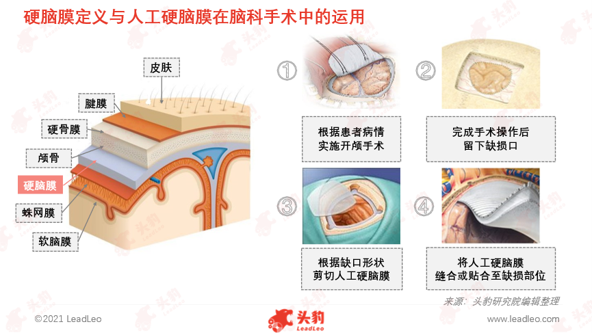 集采政策冲击,人工硬脑膜市场预期受挫